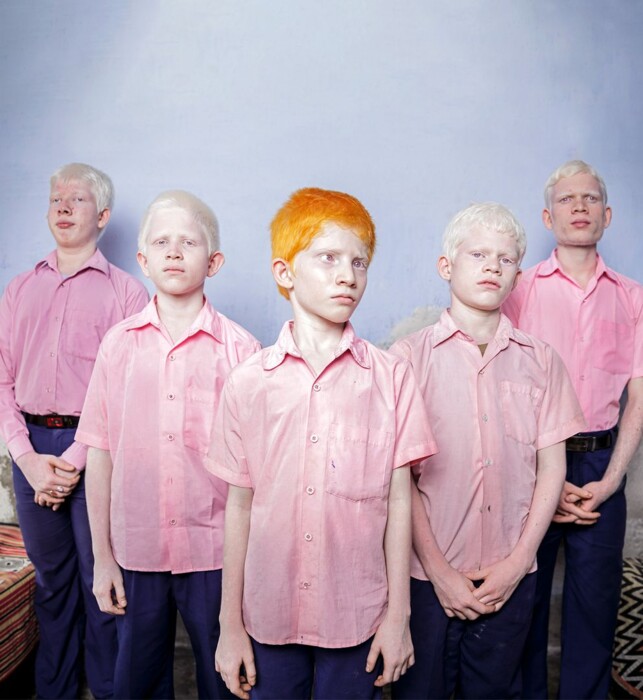 Blauwe achtergrond, 5 jongens albinisme en roze blouses aan, de voorste heeft feloranje haren, de andere jongens hebben wit haar.