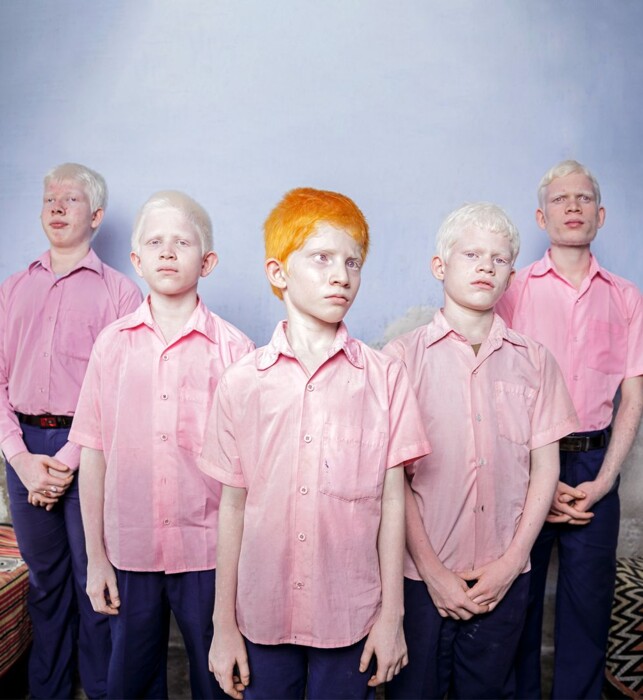 Blauwe achtergrond, 5 jongens albinisme en roze blouses aan, de voorste heeft feloranje haren, de andere jongens hebben wit haar.